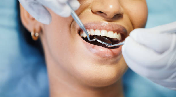 Best Knocked-Out Tooth (Avulsed Tooth) Treatment in Lansdale, PA